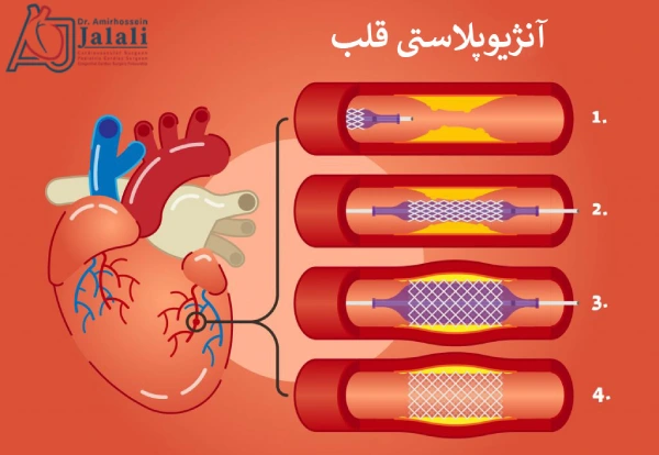 آنژیوپلاستی قلب