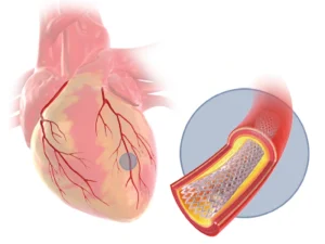آنژیوپلاستی قلب