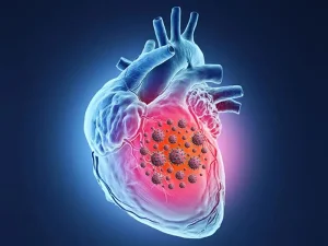 عفونت قلبی یا اندوکاردیت