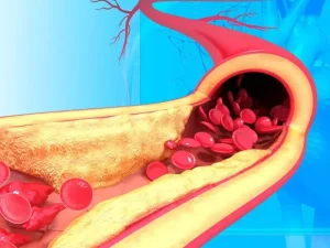 بیماری کرونر