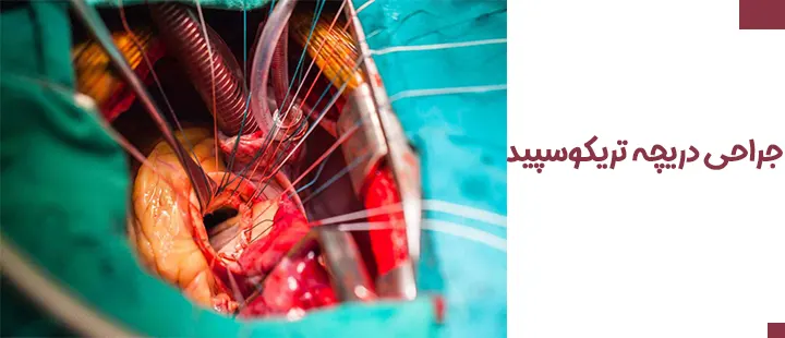 جراحی دریچه تریکوسپید