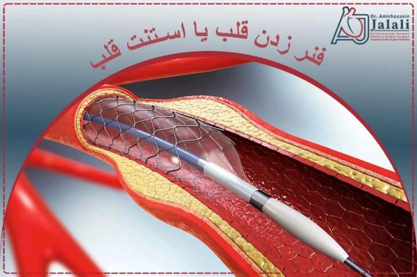 فنر زدن قلب