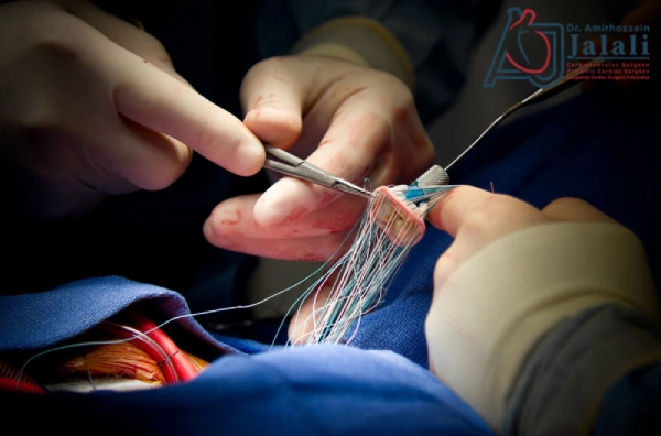 عمل تعویض دریچه میترال