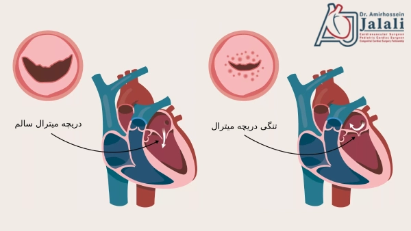 تنگی دریچه میترال