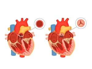 هر آنچه باید درباره تنگی دریچه میترال بدانید