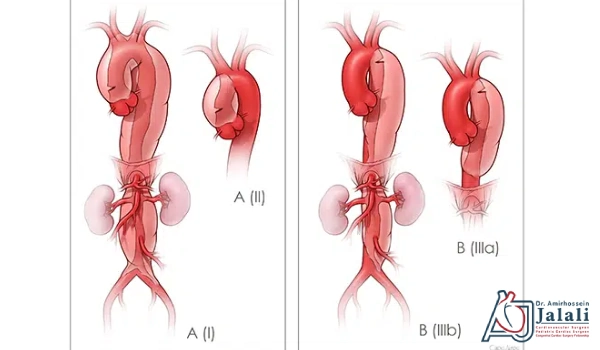 انواع دایسکشن آئورت