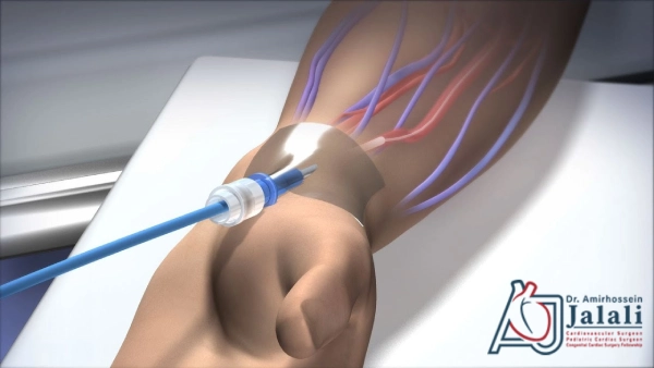 آنژیوگرافی از راه دست چیست؟