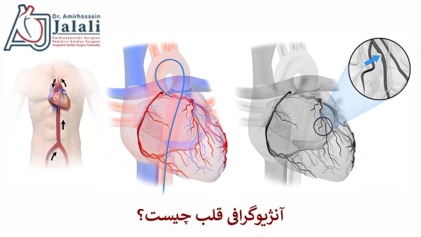 آنژیوگرافی قلب