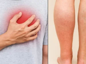 ورم پا در بیماران قلبی