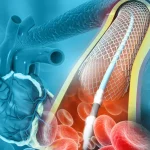 تفاوت بالن و فنر قلب؛ کدام روش برای شما بهتر است؟