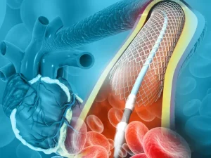 تفاوت بالن و فنر قلب؛ کدام روش برای شما بهتر است؟